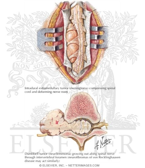 Watermarked preview of labeled image: Intradural Extramedullary Tumors of Spinal Cord