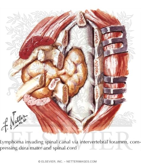 Watermarked preview of labeled image: Extradural Tumors