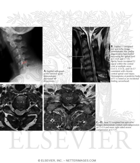 Watermarked preview of labeled image: Idiopathic Spinal Stenosis