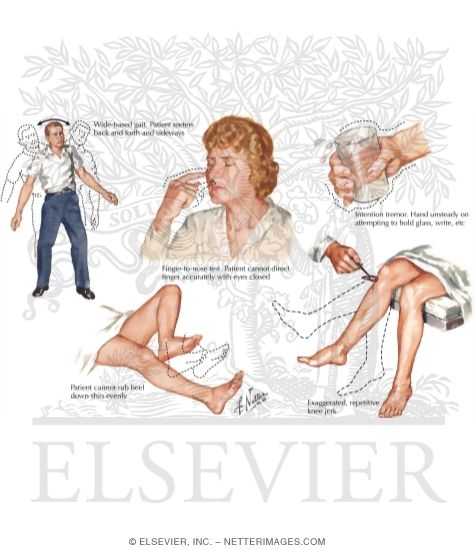 Multiple Sclerosis: Cerebellar and Brain Stem Manifestations