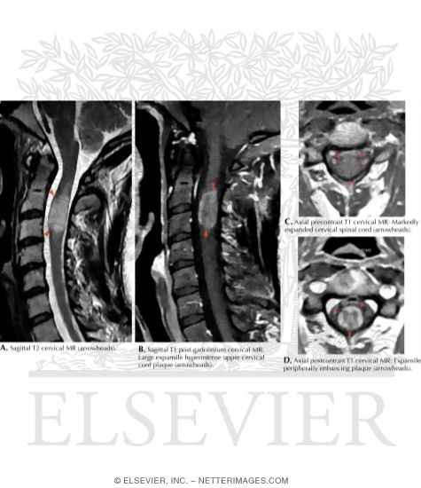 Spinal Cord MRI In Multiple Sclerosis