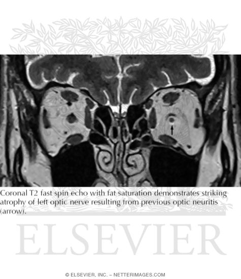 Watermarked preview of labeled image: Optic Nerve Atrophy