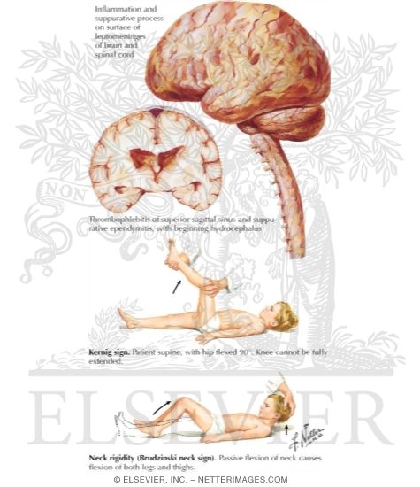 Watermarked preview of labeled image: Bacterial Meningitis