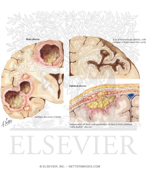Parameningeal Infections and Subdural Abscess