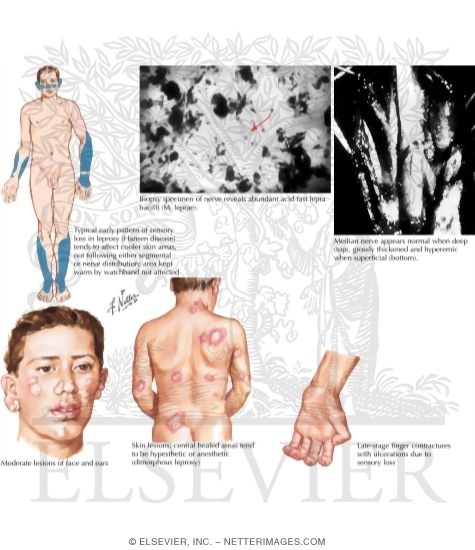 Leprosy
