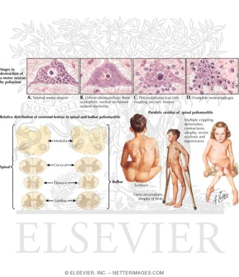 Watermarked preview of labeled image: Poliomyelitis