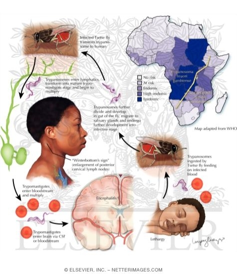 Trypanosomiasis: African Sleeping Sickness