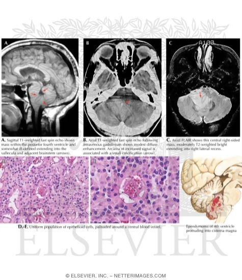 Ependymoma