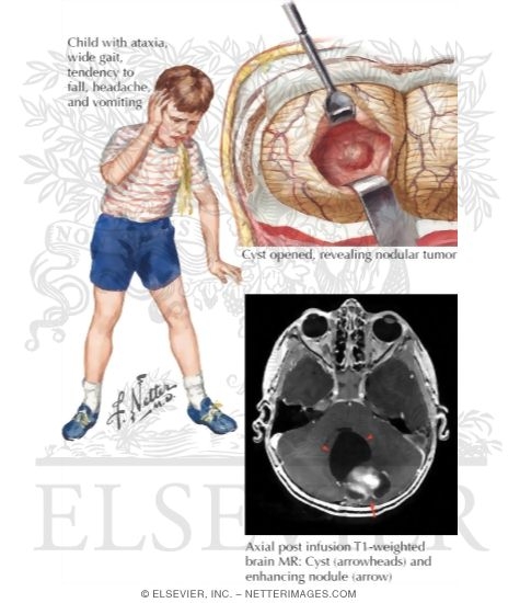 Watermarked preview of labeled image: Cystic Astrocytoma of Cerebellum