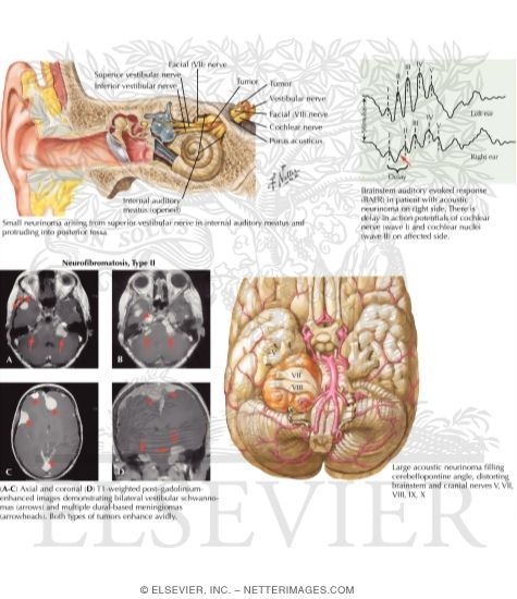 Watermarked preview of labeled image: Acoustic Neurinomas