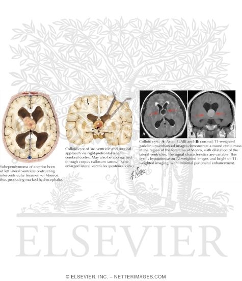 Watermarked preview of labeled image: Intraventricular Tumors