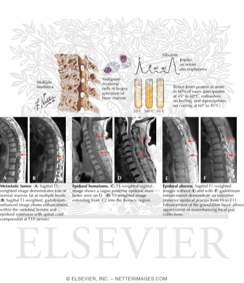 Extradural Primary Malignant Spinal Tumors