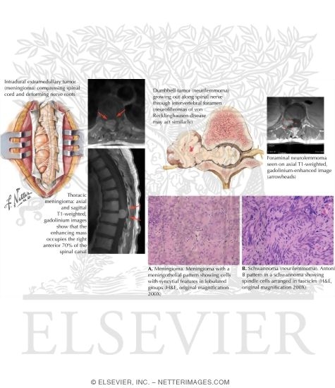 Watermarked preview of labeled image: Intradural Extramedullary Primary Spinal Tumors
