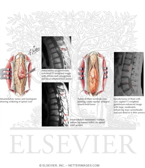 Watermarked preview of labeled image: Intradural Intramedullary Primary Spinal Cord Tumors