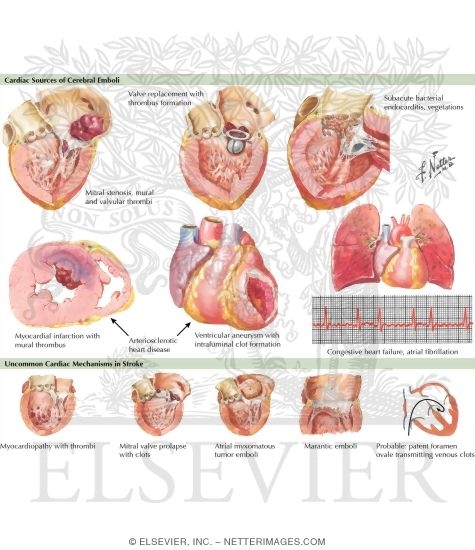 Cardiac Embolism
