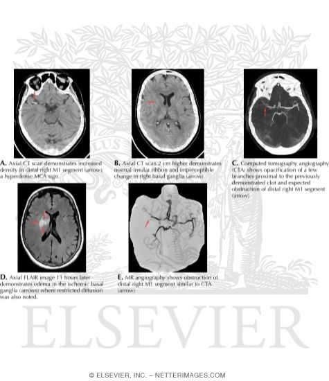 Watermarked preview of labeled image: Acute Ischemic Infarct With a Right Middle Cerebral Artery Clot