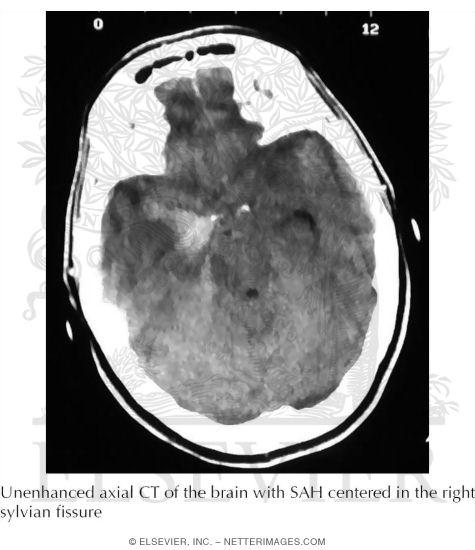 Subarachnoid Hemorrhage