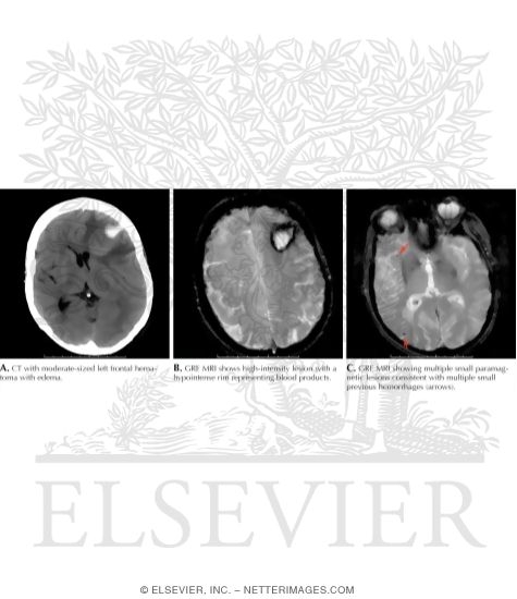 Amyloid Angiopathy