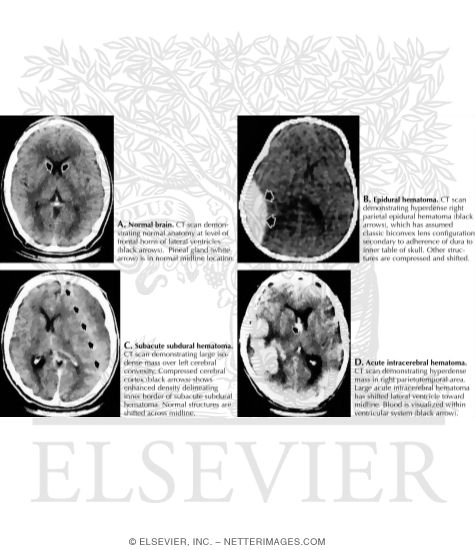 Watermarked preview of labeled image: CT and Angiogram of ICH