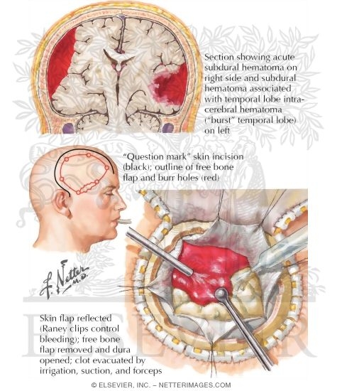 Subdural Hematomas