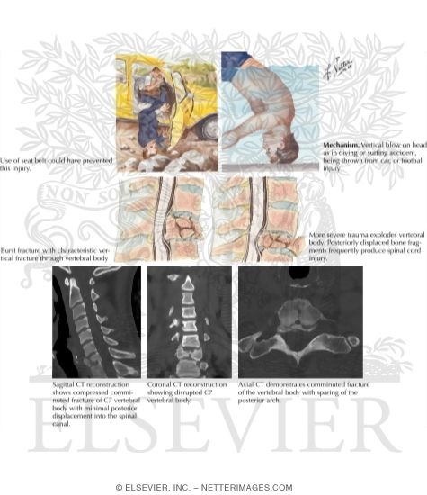 Watermarked preview of labeled image: Cervical Spine Injury: Compression