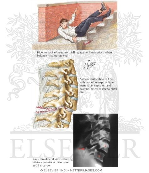 Cervical Spineinjury: Hyperextension Flexion-Rotation