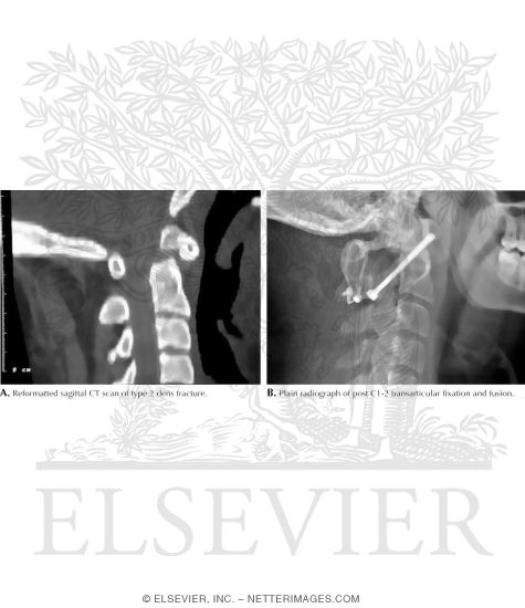 Watermarked preview of labeled image: Dens Fracture of Cervical Spine