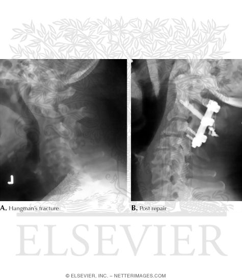 Plain Radiograph of Hangman's Fracture: Cervical Spine