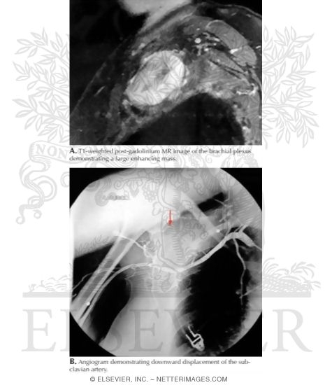 Desmoid Tumor