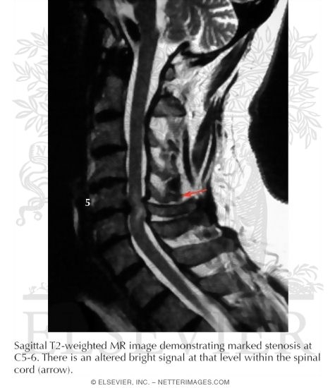 Cervical Spinal Stenosis