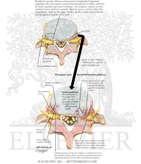 Role of Inflammation In Lumbar Pain