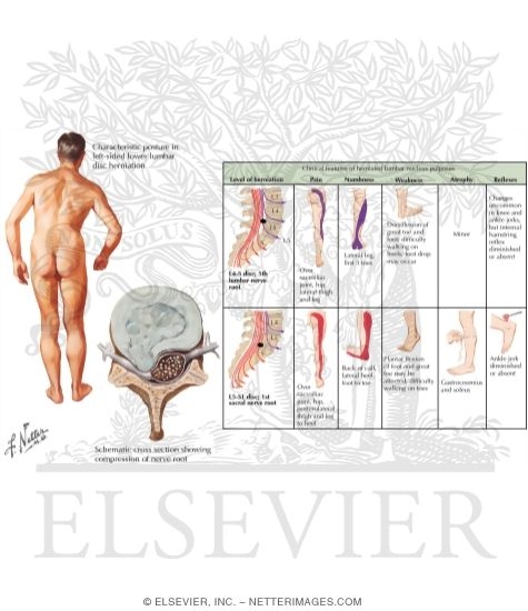 Lumbar Disc Herniation: Clinical Manifestations