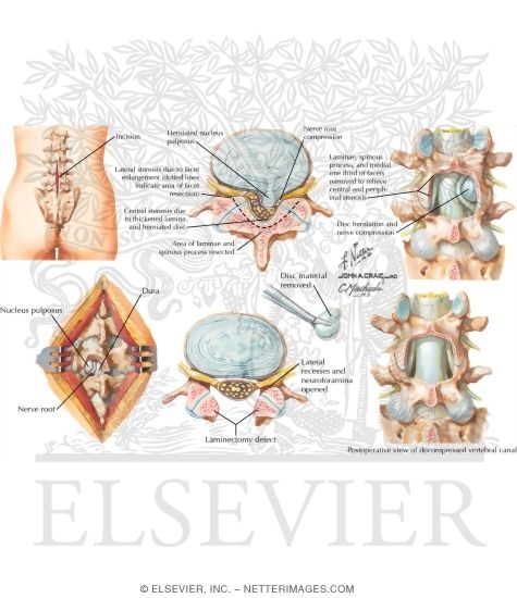 Watermarked preview of labeled image: Laminectomy and Discectomy