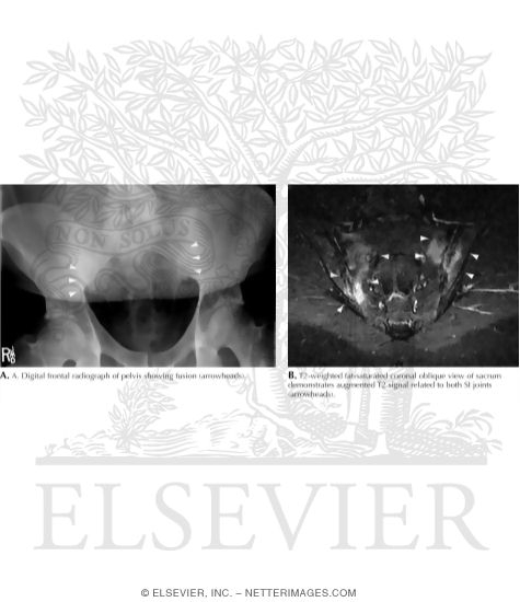 Watermarked preview of labeled image: Fusion of Sacroiliac Joints In 28-Year-Old Man With Ankylosing Spondylitis