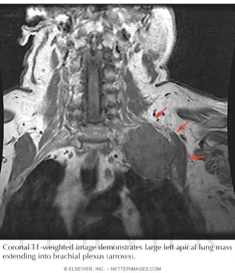 Watermarked preview of labeled image: Apical Lung Tumor Invading Left Brachial Plexus