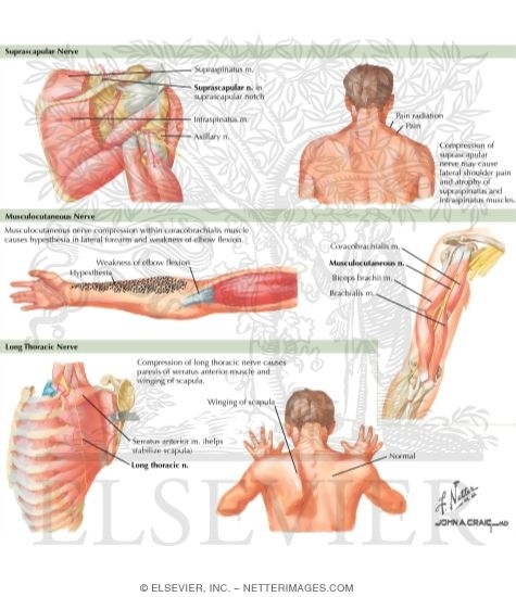 Watermarked preview of labeled image: Neuropathy About Shoulder
