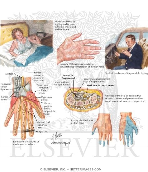 Watermarked preview of labeled image: Carpal Tunnel Syndrome