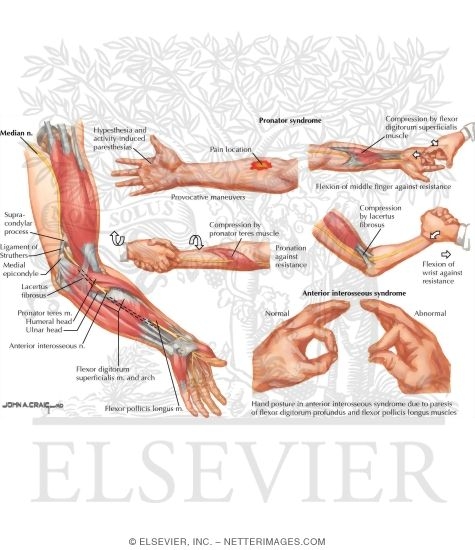 Proximal Compression of Median Nerve