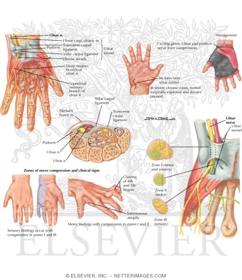 Watermarked preview of labeled image: Ulnar Tunnel Syndrome