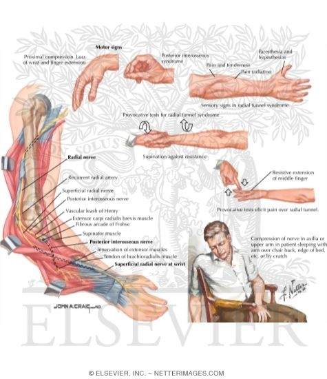 Radial Nerve Compression