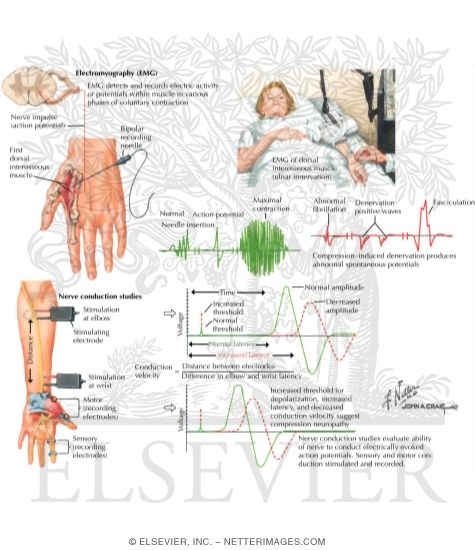 Electrodiagnostic Studies In Compression Neuropathy