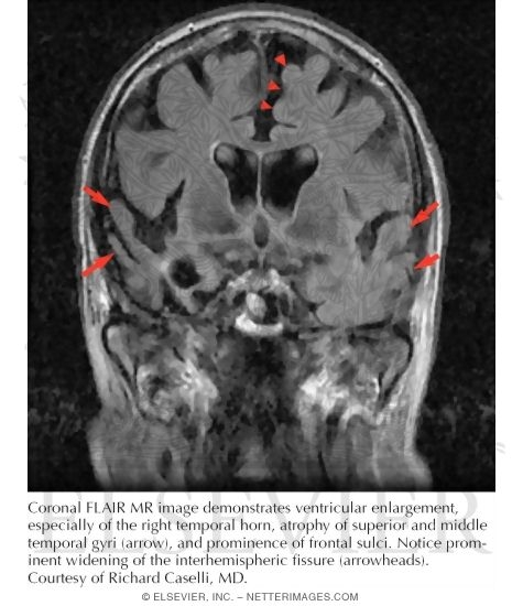 Frontal Temporal Atrophy