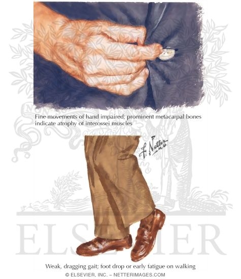 Motor Neuron Disease: Early Clinical Manifestation