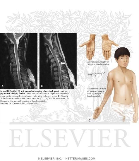 Watermarked preview of labeled image: Hirayama Disease