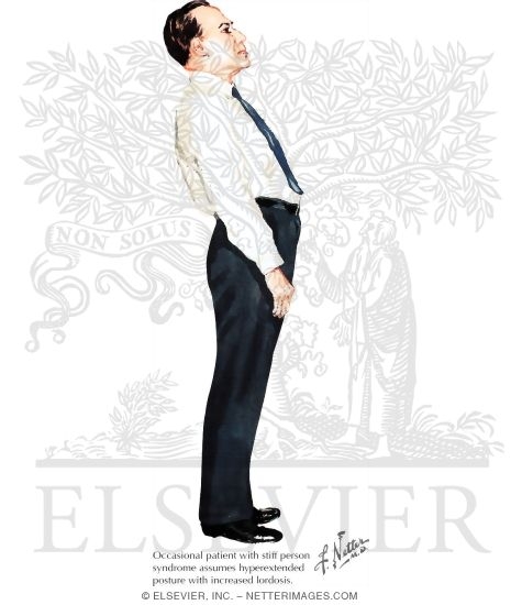 Stiff Person Syndrome