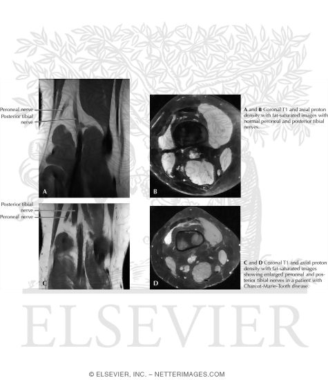 MRI Findings In Charcot-Marie-Tooth Disease, With Normal Comparison