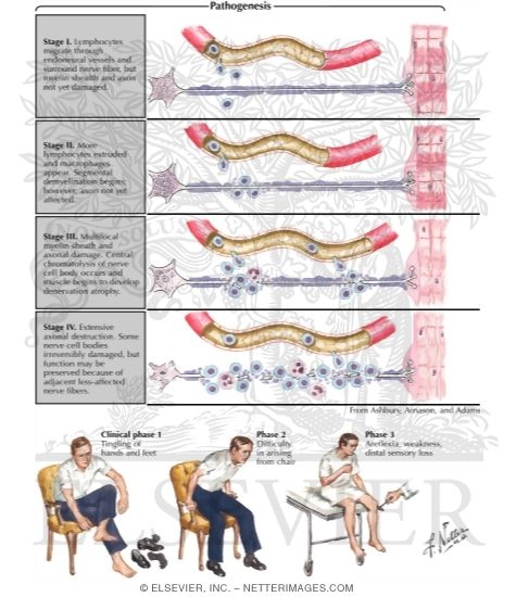 AIDP (Guillain-Barre Syndrome)