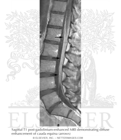 Watermarked preview of labeled image: Guillain-Barre