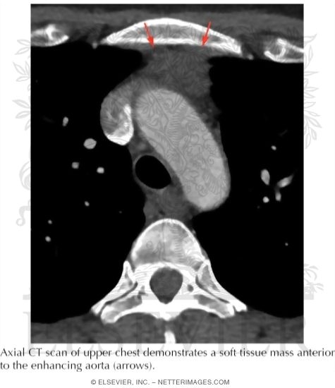 Thymoma