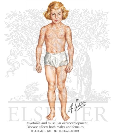 Myotonia Congenita (Thomsen Disease)